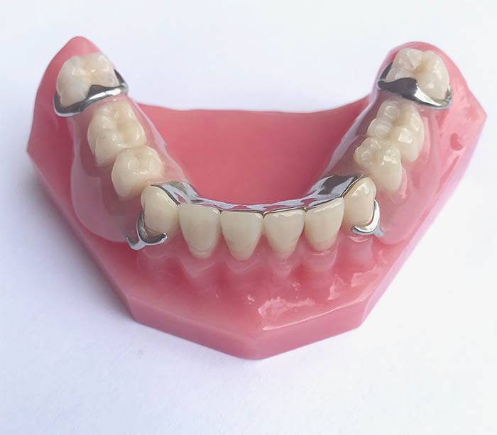 Clasp Types For Partial Dentures At Dustin Coats Blog Clasp Types For Partial Dentures At Dustin Coats Blog