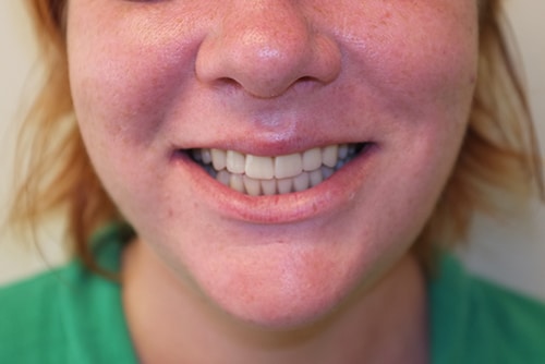 Smile After Custom Dentures