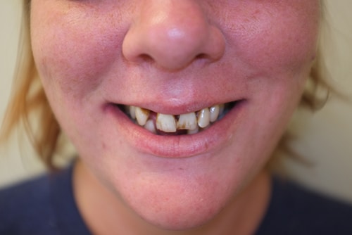 Teeth Before Dentures