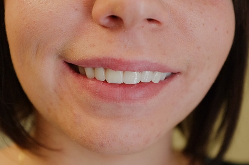 Smile After New Dentures