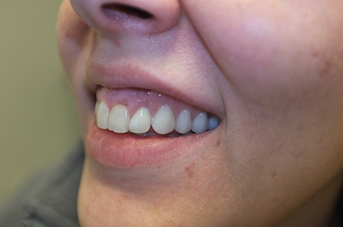 Partial Dentures Result in Perfect Smile