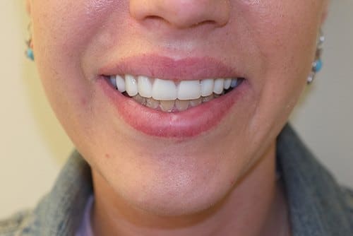 Custom Dentures Result in Perfect Smile