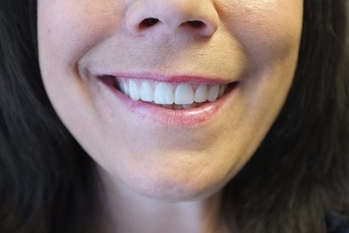 Beautiful Smile with Handcrafted Dentures