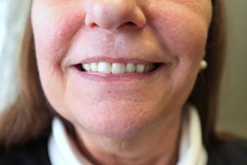 Handcrafted Dentures - Nice Smile