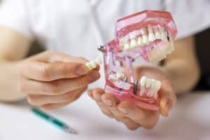 A dentist holding a plastic model of dental implants.
