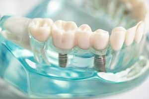 A close-up picture of a model of all-on-4 dental implants.