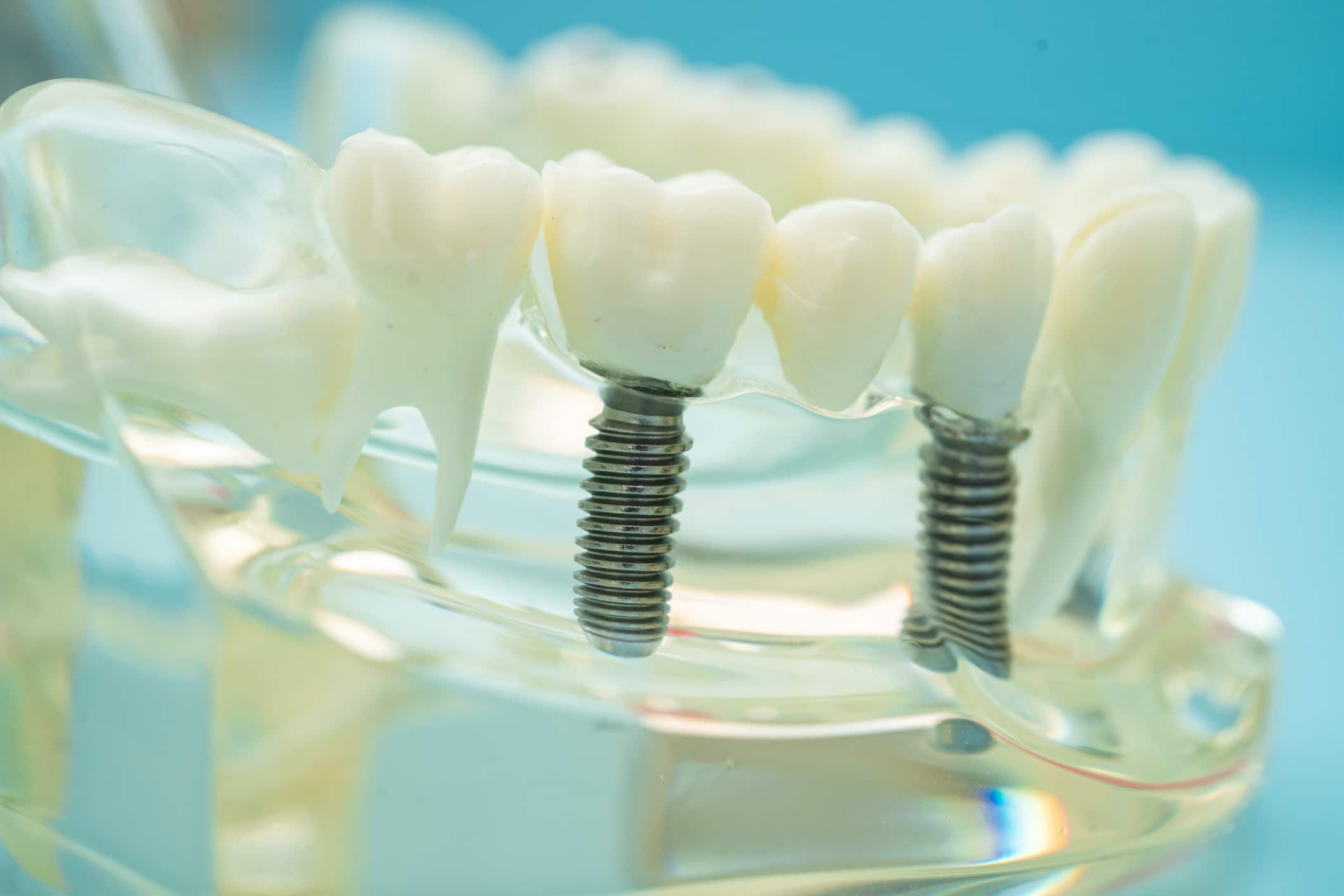 A close-up of a model of implant restorations.